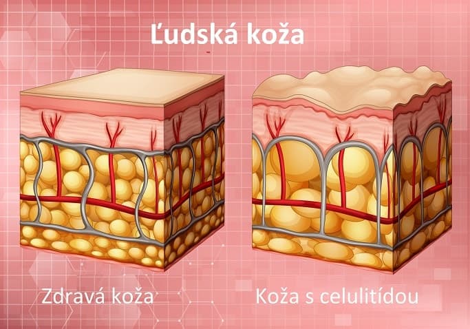 Celulitída na koži