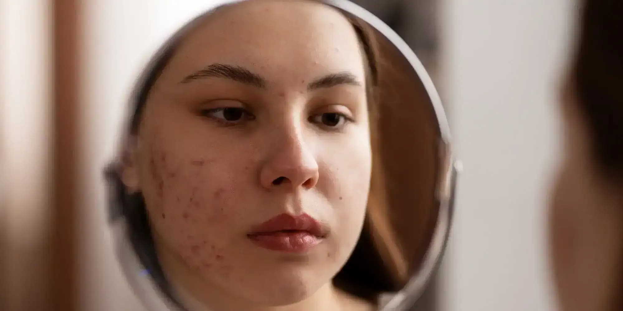 žena s akné sa pozerá do zrkadla
