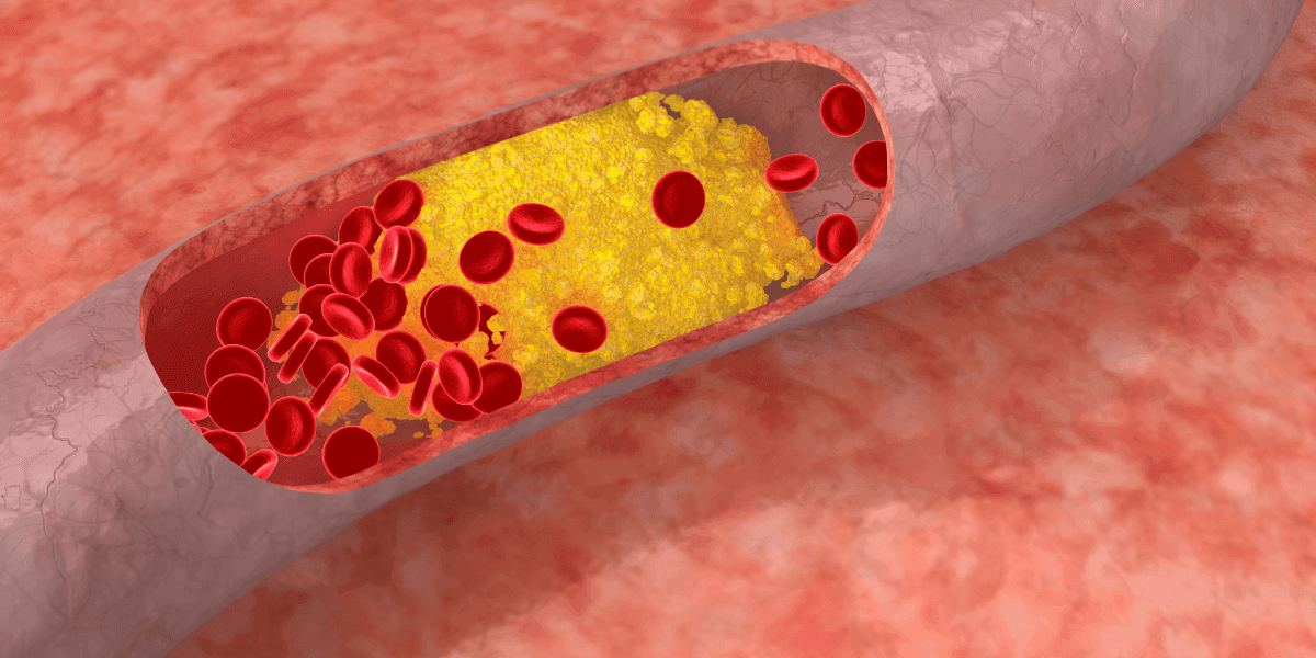 doplnky stravy na zníženie cholesterolu upchaté cievy